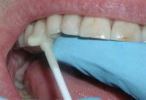 Pic-n-Stic-Handle for Small Objects-Pulpdent-Dental Supplies