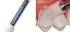 Luminescene Gel Syringe 3gm - Premier - Dental Supplies