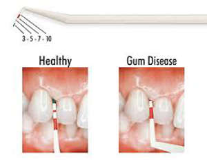Periowise Probe-Premier Dental-Dental Supplies	