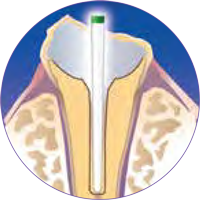Cure-Thru® IntegraPost®  - Zirconia Glass Fiber Posts 10/pk - Premier Dental