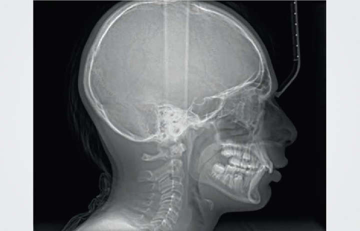 Duray 2D Ceph Extraoral X-Ray Series - Beyes Dental